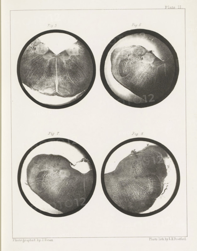 Four cross-sections of a medulla oblongata of a sheep, page, photomechanical print, number: 'Plate II. Fig. 5. Fig 6. Fig. 7. Fig. 8.', photographer: John Dean, printmaker: Bradford & Co, LH, c. 1854 - in or before 1864, paper, photolithography, height 301 mm x width 230 mm, brains, A pale rectangular sheet contains four circular grayscale images arranged two above two, each circle rimmed by a dark border and showing textured, irregular organic surfaces with varying light and dark shading. The top left circle shows a roughly symmetrical form with a central lighter vertical area and radiating fine striations, while the top right circle displays an asymmetrical rounded mass with mottled highlights and a lighter halo near the rim. The bottom left circle features a large rounded shape with subtle linear textures and a lighter curved edge, and the bottom right circle shows a similar rounded form with finer mesh-like patterns and a brighter area near its upper edge. The background of the she...