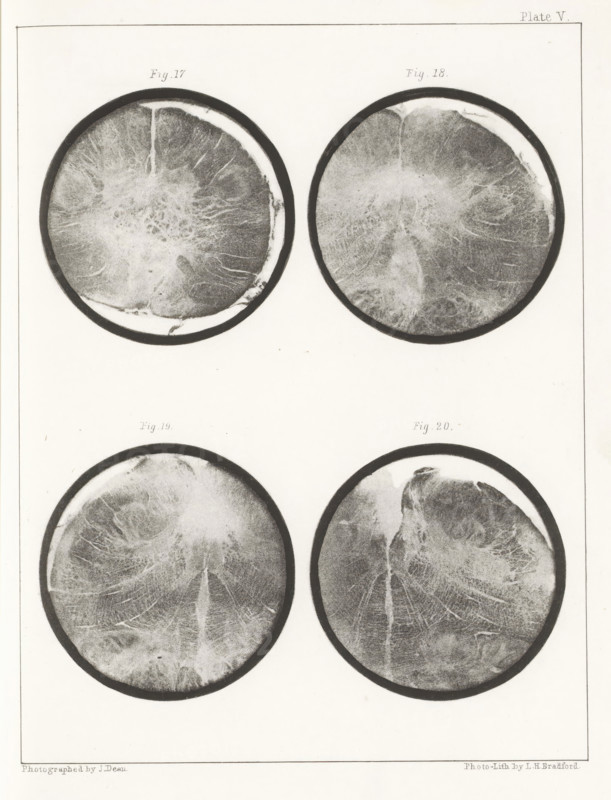 Four details of a human medulla oblongata, page, photomechanical print, number: 'Plate V. Fig. 17. Fig 18. Fig. 19. Fig. 20.', photographer: John Dean, printmaker: Bradford & Co, LH, c. 1854 - in or before 1864, paper, photolithography, height 301 mm x width 230 mm, brains, A vertically oriented sheet with four circular grayscale images arranged in two columns and two rows, each circle showing textured radial patterns and irregular lighter and darker areas within a dark outer rim, with subtle mottling and vein-like streaks; faint printed labels appear above each top circle and between the two rows, and a thin rectangular border frames the entire sheet.