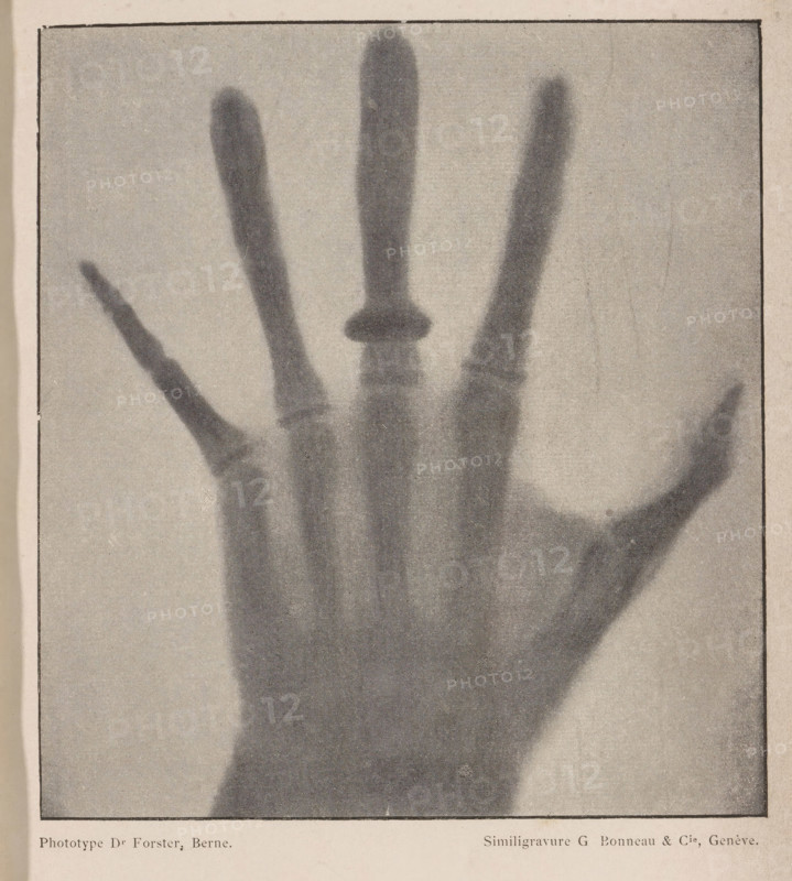 Revue Suisse de photographie, 1896, page, photomechanical print, maker: Dr. Foster, maker: G. Bonneau & Cie, c. 1891 - in or before 1896, paper, autotypie, height 140 mm x width 128 mm, X-ray examination, carpus and metacarpus, parts of the hand, A grainy monochrome image of a human hand seen from the palm side with fingers splayed, showing darker shadowy areas where the fingers and palm appear as semi-transparent silhouettes, with one finger topped by a darker rounded shape, all set against a lighter textured background within a rectangular border.
