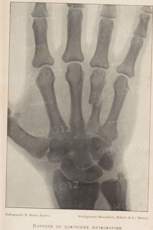 Rupture du Quatrième Métacarpien, X-ray of a hand with a broken metacarpal, page, photomechanical print, photographer: Dr. Késer, cliché maker: Meisenbach, Riffarth & Cie., Munich, c. 1893 - in or before 1898, Bavaria, paper, autotypie, height 167 mm x width 116 mm, X-ray examination, carpus and metacarpus, parts of the hand, A grayscale radiographic image of a human hand showing bones from the wrist through the finger phalanges, with visible metacarpal and phalangeal shafts and joint spaces; the bones appear with varied shading and grainy texture against a lighter background, and the image is framed by a thin border with a narrow margin around it.