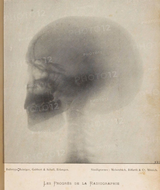 X-ray of a human skull, Les Progrès de la Radiography, page, photomechanical print, photographer: Reiniger, Gebbert & Schall, cliché maker: Meisenbach, Riffarth & Cie., Munich, c. 1893 - in or before 1898, Bavaria, paper, autotypie, height 147 mm x width 142 mm, X-ray examination, (human) skull, A faded grayscale image shows a side view of a human skull rendered in soft, grainy tones against a lighter background, with darker shading outlining the cranial dome, eye socket, nasal cavity, and jaw area; the lower portion of the image includes a pale rectangular border and a strip of aged paper with faint stains and small specks, and the overall appearance is textured with subtle spots and vertical streaks.