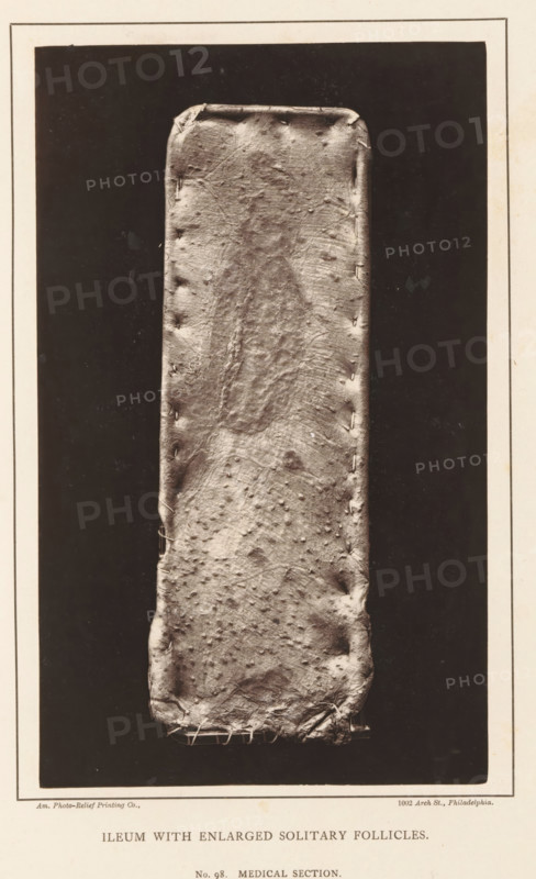 Ileum with Enlarged Solitary Follicles, page, photomechanical print, address: '1002 Arch St., Philadelphia.', number: 'No. 98. MEDICAL SECTION.', photographer: Edward J. Ward, cliché maker: American Photo-Relief Printing Company, Philadelphia, c. 1874 - in or before 1879, North America, paper, Woodburytype, Woodburytypepie, height 200 mm x width 121 mm, anatomical specimen, intestines, A tall, narrow rectangular object with rounded corners fills the central vertical space, its surface showing a textured, irregular pattern with small raised bumps and creases; the rectangle appears to be stitched along both long edges and the bottom, with visible thread loops at the lower edge, and it is set against a dark rectangular background framed by a lighter border.