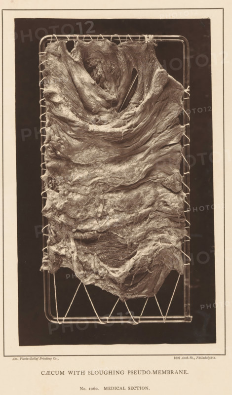 Caecum with Sloughing Pseudo-Membrane, page, photomechanical print, address: '1002 Arch St., Philadelphia.', number: 'No. 1060. MEDICAL SECTION.', photographer: Edward J. Ward, cliché maker: American Photo-Relief Printing Company, Philadelphia, c. 1874 - in or before 1879, North America, paper, Woodburytype, height 198 mm x width 120 mm, anatomical specimen, intestines, A vertical photographic image shows a textured, layered organic sheet stretched and secured by cords to a rectangular metal frame, the sheet displaying folds, ridges, and fibrous surfaces with varied light and shadow; the frame rests against a dark background and is bordered by a pale mat with a printed strip along the bottom.