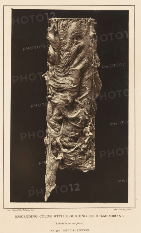 Descending Colon with Sloughing Pseudo-Membrane, page, photomechanical print, address: '1002 Arch St., Philadelphia', number: 'No. 970. MEDICAL SECTION.', inscription: '(Reduced in size one-fourth)', photographer: Edward J. Ward, cliché maker: American Photo-Relief Printing Company, Philadelphia, c. 1874 - in or before 1879, North America, paper, Woodburytype, height 200 mm x width 122 mm, anatomical specimen, intestines, A tall vertical photographic image centered on a rectangular dark background shows a long irregular organic mass suspended within a narrow rectangular frame; the mass has layered, wrinkled, and folded surfaces with many torn, ribbonlike strands and rounded cavities, with a tapered, elongated lower portion that hangs below the frame and a thicker upper section gathered at the top, all rendered in a sepia tone against a pale border.