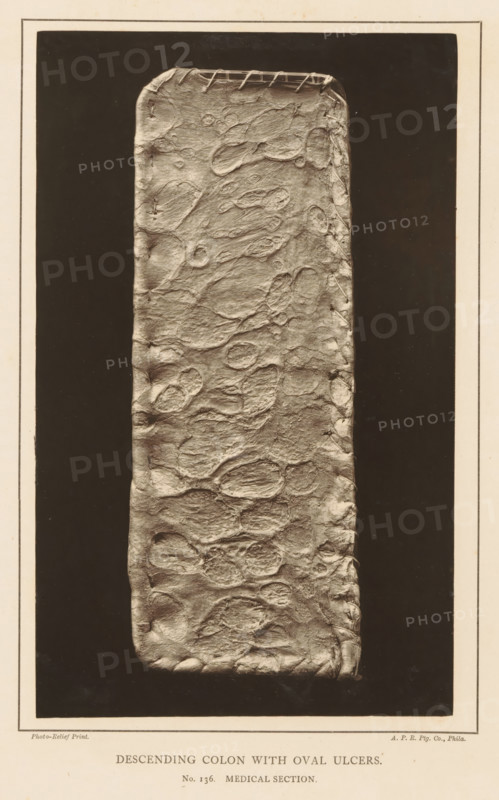Descending Colon with Oval Ulcers, page, photomechanical print, number: 'No. 136. MEDICAL SECTION.', photographer: Edward J. Ward, cliché maker: American Photo-Relief Printing Company, Philadelphia, c. 1874 - in or before 1879, North America, paper, Woodburytype, Woodburytypepie, height 202 mm x width 124 mm, anatomical specimen, intestines, ulcer, A vertical rectangular panel with rounded corners fills the center, showing a textured surface with irregular oval depressions and raised areas, stitched along the top edge and partially along the right side; the panel sits on a dark rectangular background framed by a lighter border, and a light margin surrounds the whole image.