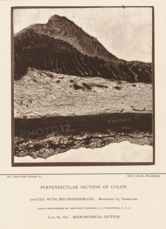Enlargement of a membrane in a piece of large intestine, Perpendicular Section of Colon Coated with Pseudomembrane, page, photomechanical print, inscription: 'Magnified 63 diameters., Photo-micrograph by assistant surgeon JJ Woodward, USA, From No. 681. MICROSCOPICAL SECTION.', address: '624 N. 24th St., Philadelphia.', photographer: Joseph Janvier Woodward, cliché maker: American Photo-Relief Printing Company, Philadelphia, c. 1874 - in or before 1879, North America, paper, Woodburytype, Woodburytypepie, height 127 mm x width 115 mm, anatomical specimen, intestines, A rectangular framed image with a high-contrast, textured horizontal composition occupying the upper portion of a pale page; the top area shows a dark, irregular mound with dense stippled texture that slopes down into a band of lighter, finely wrinkled, layered patterns, beneath which lies a broad dark horizontal stripe with a rough surface, followed by another textured, fibrous band at the bottom of the framed area; the p...