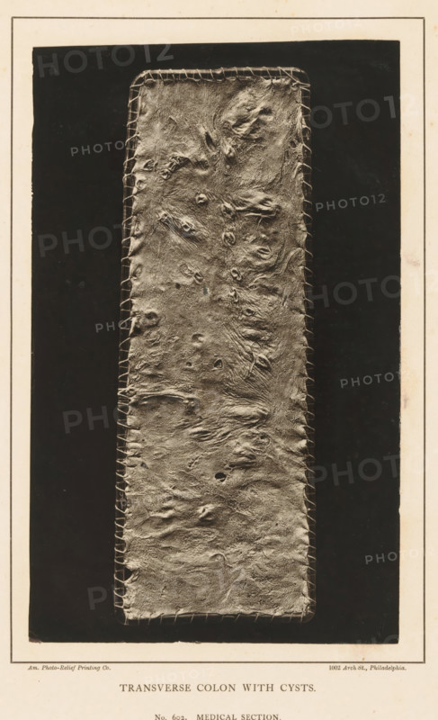 Transverse Colon with Cysts, page, photomechanical print, address: '1002 Arch St., Philadelphia.', number: 'No. 602. MEDICAL SECTION.', photographer: Edward J. Ward, cliché maker: American Photo-Relief Printing Company, Philadelphia, c. 1874 - in or before 1879, North America, paper, Woodburytype, height 196 mm x width 120 mm, anatomical specimen, intestines, A vertically oriented rectangular photographic panel shows a textured, elongated strip with irregular wrinkled surfaces and patchy raised areas, bordered by a stitched edge on both sides, set against a dark rectangular background and framed by a lighter margin.