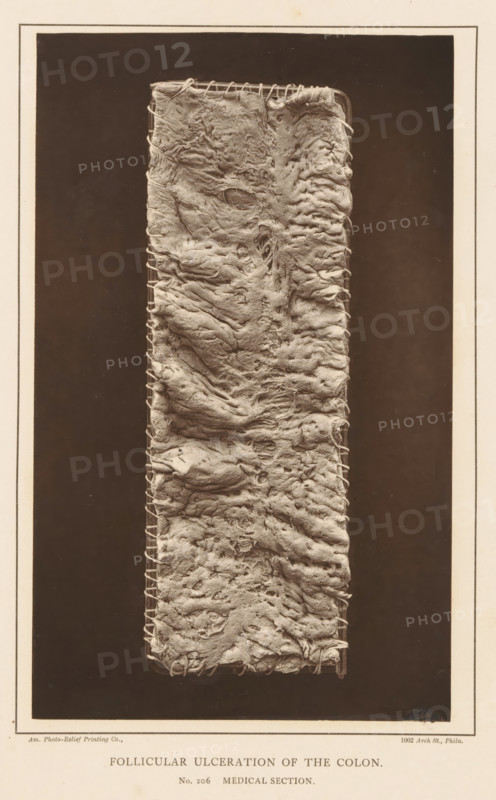 Strained section of colon with swollen cavities, Follicular Ulceration of the Colon, page, photomechanical print, number: 'No. 206. MEDICAL SECTION.', address: '1002 Arch St., Phila.', photographer: Edward J. Ward, cliché maker: American Photo-Relief Printing Company, Philadelphia, c. 1874 - in or before 1879, North America, paper, Woodburytype, height 203 mm x width 124 mm, anatomical specimen, intestines, A tall vertical rectangular strip occupies the center of the image, showing a textured, irregular surface with folds, ridges, and rough patches; the strip's edges are secured with a series of loops of thin cord or thread that run along both sides, and the surface displays various depressions, raised areas, and small holes with uneven, wrinkled material that appears layered and fibrous; the central strip is set against a dark rectangular background framed by a lighter border with a narrow inner line, and the overall image has a sepia-toned, aged photographic appearance.