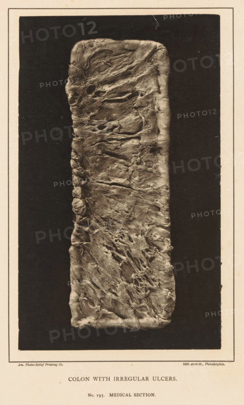 Strained section of colon with irregular ulcers, Colon with Irregular UICers, page, photomechanical print, number: 'No. 195. MEDICAL SECTION.', address: '1002 Arch St., Philadelphia.', photographer: Edward J. Ward, cliché maker: American Photo-Relief Printing Company, Philadelphia, c. 1874 - in or before 1879, North America, paper, Woodburytype, Woodburytypepie, height 199 mm x width 120 mm, anatomical specimen, intestines, ulcer, A vertically oriented rectangular photographic print centered on a pale page, featuring a long, narrow, textured object with irregular folds, ridges, and pitted surfaces against a dark background; the object appears roughly rectangular with rounded corners and shows varied tonal shading highlighting creases and depressions; a thin rectangular border surrounds the dark area, and there is printed text below the image on the page.