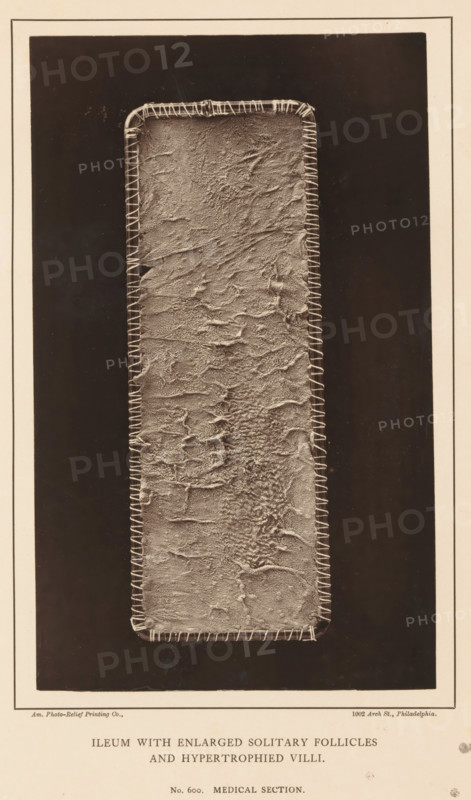 Ileum with Enlarged Solitary Follicles and Hypertrophied Villi, page, photomechanical print, address: '1002 Arch St., Philadelphia.', number: 'No. 600. MEDICAL SECTION.', photographer: Edward J. Ward, cliché maker: American Photo-Relief Printing Company, Philadelphia, c. 1874 - in or before 1879, North America, paper, Woodburytype, Woodburytypepie, height 200 mm x width 121 mm, anatomical specimen, intestines, A tall vertical rectangular panel with rounded corners fills the center, its surface textured with irregular raised ridges and rough patches, bordered by a lighter stitched edge that follows the rectangle's contour; the panel sits against a dark rectangular background with a light margin framing the entire image.