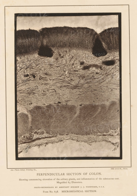 Perpendicular Section of Colon, Enlargement of the formation of ulcers in cavities in a piece of colon and inflammation of the lower layer, page, photomechanical print, address: '1002 Arch St., Phila.', inscription: 'Showing commencing ulceration of the solitary glands, and inflammation of the submucous coat., Magnified 63 Diameters., Photo-micrograph by assistant surgeon JJ Woodward, USA, From No. 658. MICROSCOPICAL SECTION.', photographer: Joseph Janvier Woodward, cliché maker: American Photo-Relief Printing Company, Philadelphia, c. 1874 - in or before 1879, North America, paper, Woodburytype, Woodburytypepie, height 159 mm x width 115 mm, anatomical specimen, intestines, ulcer, A rectangular photographic plate bordered by a dark frame sits centered on aged paper, showing a vertical grayscale microscopic image with distinct horizontal bands of texture; the top band features a dark, densely stippled layer with rounded, mound-like protrusions and irregular darker spots, the middle ban...