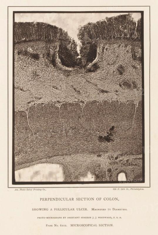 Enlargement of a distended cavity in a piece of large intestine, Perpendicular Section of Colon, Showing a Follicular Ulcer, page, photomechanical print, inscription: 'Magnified 70 Diameters., Photo-micrograph by assistant surgeon JJ Woodward, USA, From No. 6102. MICROSCOPICAL SECTION.', address: '624 N. 24th St., Philadelphia.', photographer: Joseph Janvier Woodward, cliché maker: American Photo-Relief Printing Company, Philadelphia, c. 1874 - in or before 1879, North America, paper, Woodburytype, height 153 mm x width 117 mm, anatomical specimen, intestines, ulcer, A rectangular sepia-toned image framed by a double border shows a vertical cross-sectional view with textured layers and cellular patterns. The top portion features a dark, densely stippled region with an inward-curving depression and rough edges, while the middle displays a lighter, grainy band with varied texture and scattered denser spots. Below this band are vertical column-like structures with fine granular detail, be...