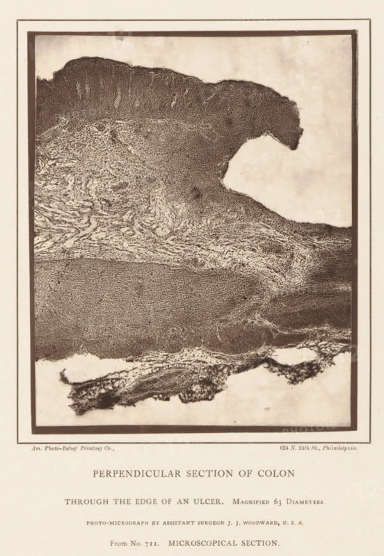 Perpendicular Section of Colon, through the Edge of an Ulcer, Enlargement of the edge of an ulcer in a piece of colon, page, photomechanical print, address: '624 N. 24th St., Philadelphia.', inscription: 'Magnified 63 Diameters., Photo-micrograph by assistant surgeon JJ Woodward, USA, From No. 711. MICROSCOPICAL SECTION.', photographer: Joseph Janvier Woodward, cliché maker: American Photo-Relief Printing Company, Philadelphia, c. 1874 - in or before 1879, North America, paper, Woodburytype, Woodburytypepie, height 138 mm x width 113 mm, anatomical specimen, intestines, ulcer, A rectangular framed image shows a textured, irregularly shaped dark mass against a lighter background, with dense granular areas and layered, wavy striations; the top right edge of the dark mass forms a prominent rounded protrusion into the pale space, and the lower portion displays fibrous, swirling patterns transitioning into a more compact, dotted texture near the center; a narrow border surrounds the framed ...