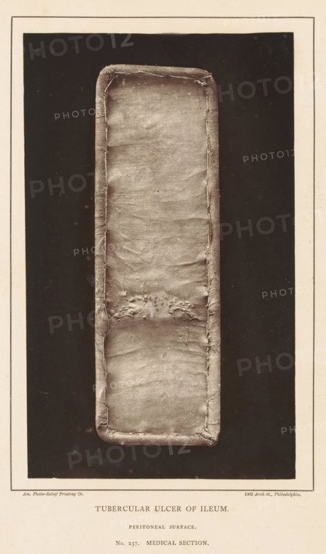 Tubercular Ulcer of Ileum, Stretched piece of ileum with an ulcer due to tuberculosis, page, photomechanical print, number: 'Peritoneal surface., No. 257. MEDICAL SECTION.', address: '1002 Arch St., Philadelphia.', photographer: Edward J. Ward, cliché maker: American Photo-Relief Printing Company, Philadelphia, c. 1874 - in or before 1879, North America, paper, Woodburytype, Woodburytypepie, height 198 mm x width 120 mm, anatomical specimen, intestines, ulcer, A vertically oriented rectangular photograph shows a long narrow strip with rounded corners centered on a dark background, bordered by a light mat with a thin inner frame; the strip has a textured fabric-like surface with visible creases, stitched edges, and a cluster of irregular raised areas near the middle, and the overall image palette is sepia-toned.