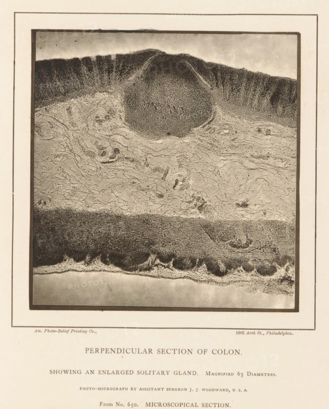 Enlargement of a swollen gland in a piece of large intestine, Perpendicular Section of Colon Showing an Enlarged Solitary Gland, page, photomechanical print, inscription: 'Magnified 63 diameters., Photo-micrograph by assistant surgeon JJ Woodward, USA, From No. 650. MICROSCOPICAL SECTION.', address: '1002 Arch St., Philadelphia', photographer: Joseph Janvier Woodward, cliché maker: American Photo-Relief Printing Company, Philadelphia, c. 1874 - in or before 1879, North America, paper, Woodburytype, Woodburytypepie, height 125 mm x width 120 mm, anatomical specimen, intestines, A rectangular framed grayscale microscopic image fills the page, showing a textured cross section with layered bands and intricate fibrous patterns; the top area contains a dark rounded mound with densely stippled texture and radiating striations, the middle shows lighter swirled and wavy fibrous tissue with irregular clumps and voids, and the lower region presents a darker horizontal band above a lighter smooth ...