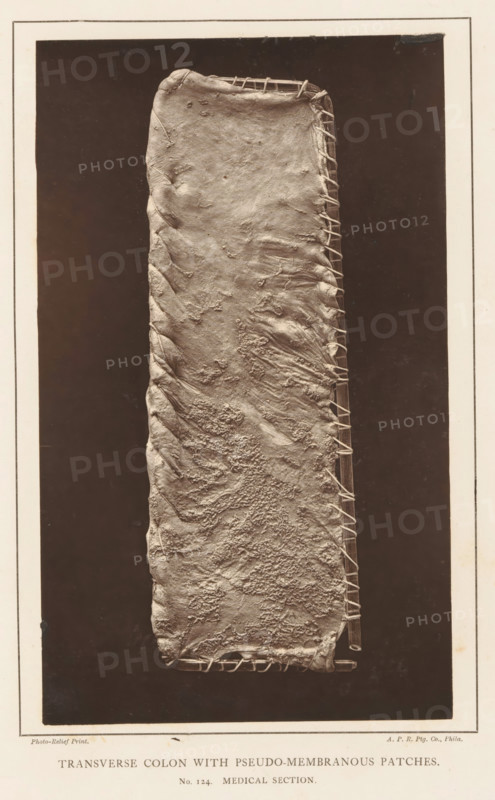 Transverse Colon with Pseudo-Membranous Patches, Stretched section of transverse intestine with membranes, page, photomechanical print, number: 'No. 124. MEDICAL SECTION.', photographer: Edward J. Ward, cliché maker: American Photo-Relief Printing Company, Philadelphia, c. 1874 - in or before 1879, North America, paper, Woodburytype, height 201 mm x width 120 mm, anatomical specimen, intestines, A vertical rectangular object with a textured, irregular surface held taut over a narrow frame by a series of looped fastenings along one long edge, set against a dark rectangular background and surrounded by a lighter border.