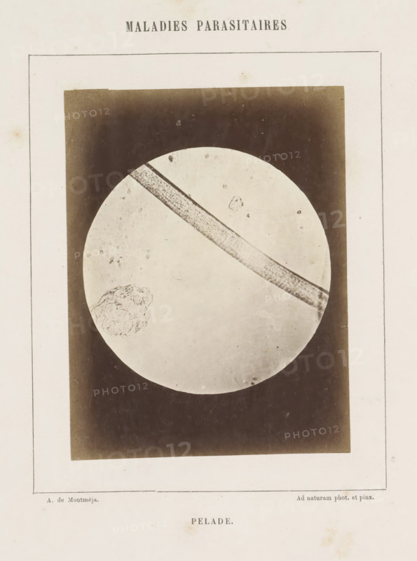 Microscopic image of the disease alopecia areata, Pelade, photograph, page, inscription: 'Ad naturam phot. et pinx.', inscription: 'Maladies parasitaires', number: '14', photographer: A. de Montméja, c. 1860 - c. 1868, paper, albumen print, height 119 mm x width 90 mm, microscope, skin and venereal diseases, A vertically oriented aged page with a rectangular framed image centered on it, showing a circular pale field against a dark background; a long textured diagonal band crosses the circular field from upper left toward lower right and a rough irregular cluster shape appears near the lower left inside the circle, with small scattered specks and marks visible on the pale circle and the surrounding dark area; the paper shows slight discoloration and faint stains around the edges.