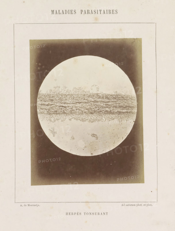 Microscopic image of ringworm on the head, Herpès tonsurant, photograph, page, number: '17', inscription: 'Ad naturam phot. et pinx.', inscription: 'Maladies parasitaires', photographer: A. de Montméja, c. 1860 - c. 1868, paper, albumen print, height 116 mm x width 91 mm, skin and venereal diseases, A faded printed page with a large rectangular dark vignette centered on it containing a circular pale area resembling a microscope view, the circular area showing horizontal textured bands and scattered granular spots, the surrounding rectangle showing uneven dark shading that lightens toward the edges, the page margin showing a thin rectangular border around the central image and faint speckles and stains on the paper.