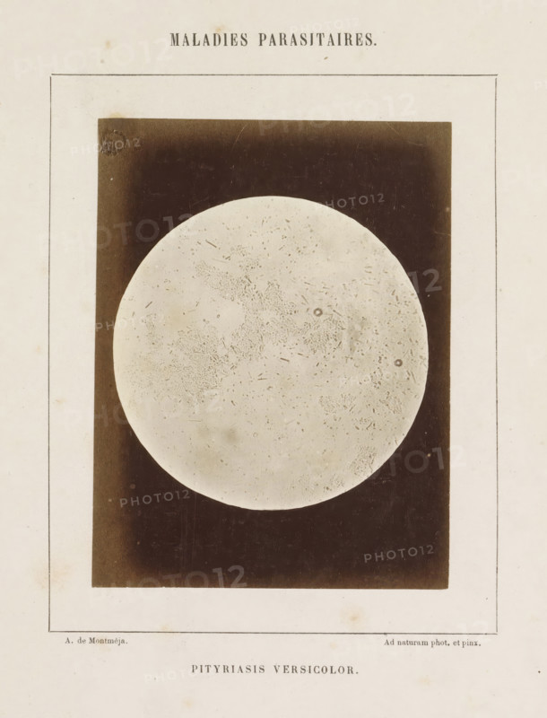 Pityriasis versicolor, Microscope image of the disease pityriasis versicolor, photograph, page, number: '19', inscription: 'Maladies parasitaires.', inscription: 'Ad naturam phot. et pinx.', photographer: A. de Montméja, c. 1860 - c. 1868, paper, albumen print, height 120 mm x width 91 mm, microscope, skin and venereal diseases, A vertical page with a centered rectangular dark panel containing a large pale circular disc that fills most of the panel, the disc showing fine irregular speckles and faint textured markings, the surrounding panel is deep brown with subtle wear and lighter edges, the page around the panel is a warm off-white with a thin double-lined rectangular border and small scattered spots and smudges.