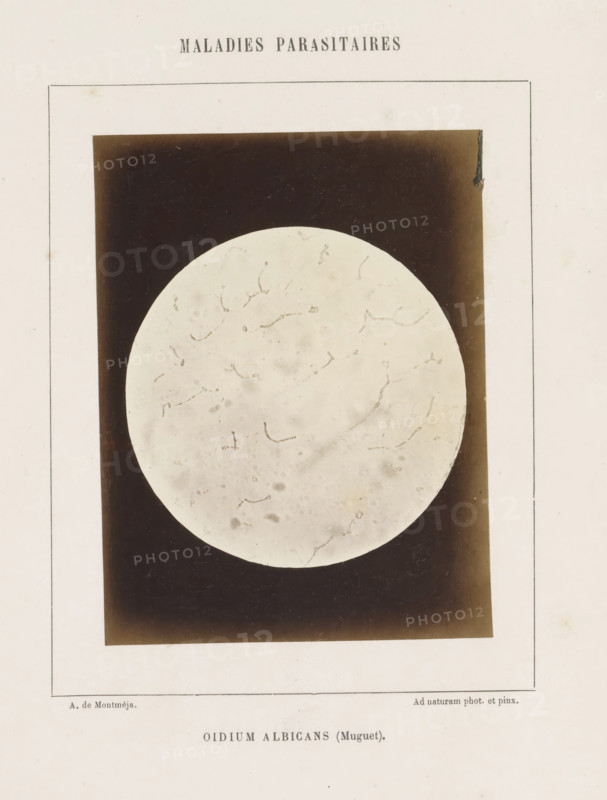 Oidium albicans (Muguet), Microscope image of probably candida albicans, photograph, page, inscription: 'Maladies parasitaires.', number: '20', inscription: 'Ad naturam photo. et pinx.', photographer: A. de Montméja, c. 1860 - c. 1868, paper, albumen print, height 120 mm x width 91 mm, microscope, skin and venereal diseases, A faded rectangular page with a thin border contains a centered dark rectangular photograph showing a large pale circular disc with faint curved and irregular markings against the dark background, small spots and smudges on the disc surface, and lighter areas near the edges of the dark rectangle; the surrounding page shows slight discoloration and small stains.