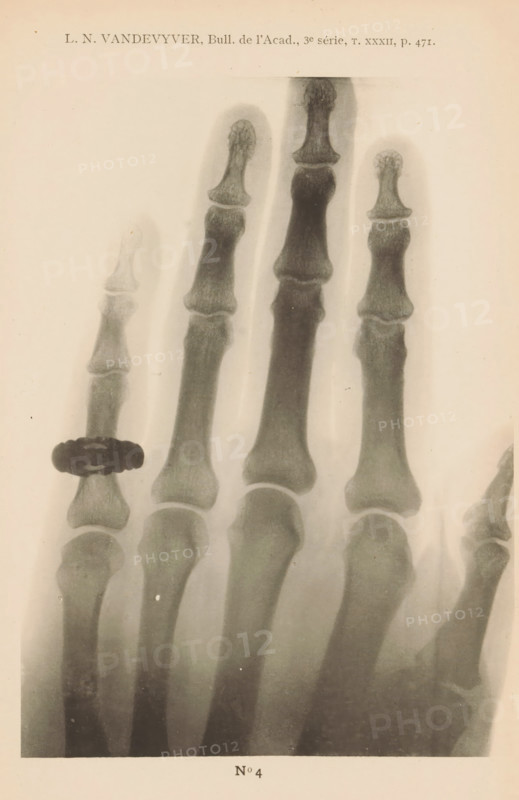 X-ray of a hand, page, photomechanical print, number: 'No 4', photographer: Guequier, Ghent, maker: E. Castelein, Brussels, c. 1891 - in or before 1896, paper, collotype, photoprint, height 168 mm x width 123 mm, Print on third unnumbered page after page 470., X-ray examination, A black-and-white radiographic image of several finger bones shown from the second joint to the tips, with one finger displaying a dark, rounded ring-like object positioned around a joint; the bones vary in darkness and texture, and soft tissue shadows are faintly visible around them.