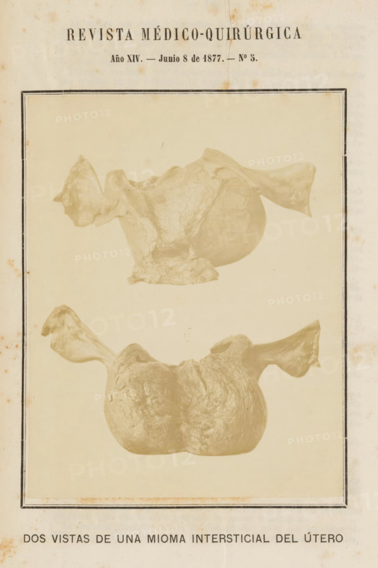 Dos Vistas de Una Mioma Intersticial del Útero, Two views of a uterus with a benign tumor formed by muscle cells, photograph, page, inscription: 'REVISTA MÉDICO-QUIRÚRGICA, Año XIV. - Junio 8 de 1877. - No 3.', c. 1872 - in or before 1877-06-08, photographer, paper, albumen print, height 141 mm x width 110 mm, womb, uterus, internal tumors, A vertical page with a faded cream background and a thin black double border contains two sepia-toned photographic views of an irregular organic mass with smooth and textured surfaces and paired winglike extensions at opposite sides, the top view showing the mass oriented with one prominent rounded lobe and a pedestal-like base and the lower view showing a broader rounded form with a central groove and outward curving winglike projections, the page showing small spots of discoloration and slightly darkened edges.