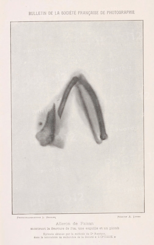 X-ray of a pheasant bone, Aileron de faison montrant la fracture de l'os, un esquille et un plomb, page, photomechanical print, inscription: 'Epreuve obtenue, &lt, L'OPTIQUE. &gt, ', photographer: Albert Londe, cliché maker: Louis Geisler, c. 1886 - in or before 1896, paper, autotypie, height 181 mm x width 120 mm, walker and runner birds: pheasant, bones in general (human body), A faded monochrome rectangular image bordered by a thin dark line sits on a pale background, showing a blurred, arching object with two curved parallel bands forming a pointed apex and tapering ends, accompanied by an amorphous irregular mass at the base where one band meets it, the tones varying from light gray to darker gray with soft, diffuse edges and a grainy texture throughout.