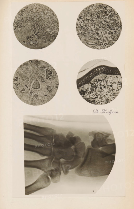 Four enlargements of x-rays, photograph, page, name: 'Drs. Hauchamps et Steinhaus', c. 1904 - in or before 1909, photographer, paper, gelatin silver print, developing gelatin silver print, height 97 mm x width 104 mm, Photo in section at the back of the book., X-ray examination, A vertical off-white page displays four circular grayscale microscopic images arranged in a grid near the top and a large rounded-corner grayscale radiographic image occupying the lower half; the circular images show dense textured patterns with varied granular and fibrous structures, one circle exhibiting a layered dark band above a lighter, mottled lower area, while the others contain irregular cellular-like clusters and porous regions; the radiographic image shows overlapping bone structures with smooth curved edges and translucent shading, highlighting joint contours and adjacent bone shapes against a lighter background.