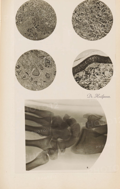 X-ray of a wrist, photograph, page, name: 'Dr. Heilporn', c. 1904 - in or before 1909, photographer, paper, gelatin silver print, developing gelatin silver print, height 76 mm x width 88 mm, Photo in section at the back of the book., X-ray examination, carpus and metacarpus, parts of the hand, A vertical cream page shows four circular grayscale microscopic images arranged near the top, each containing textured, mottled patterns with dense clustered shapes and fibrous areas; to the right of the lower right circle a cursive signature-like mark appears but is not described, and below the circles a large rectangular grayscale X-ray image of a wrist and hand bones occupies the lower half of the page, showing overlapping rounded bone ends, long narrow metacarpal shafts, joint spaces, and soft-tissue shadows with a curved white margin on the right side.