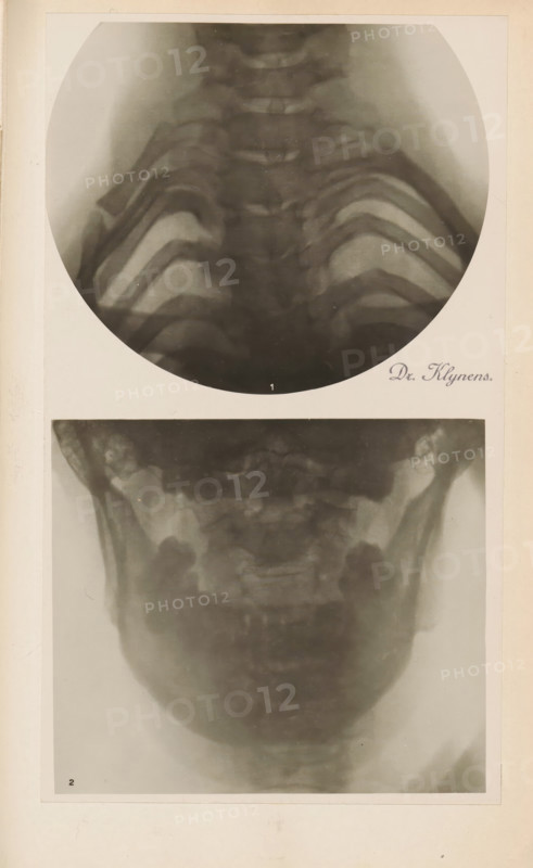 X-ray of ribs, photograph, page, name: 'Dr. Heilporn', c. 1904 - in or before 1909, photographer, paper, gelatin silver print, developing gelatin silver print, height 88 mm x width 106 mm, Photo in section at the back of the book., X-ray examination, ribs, A vertical image showing two black-and-white radiographic photographs mounted on a light background, the upper one circular and the lower one rectangular; the upper radiograph displays a series of curved, layered bone structures forming a symmetrical rib-like pattern fading toward the center, while the lower radiograph shows a rounded, jaw-like bone structure with darker shadowed areas at the sides and a lighter central region, both images surrounded by a pale mat with slight age-toned discoloration.