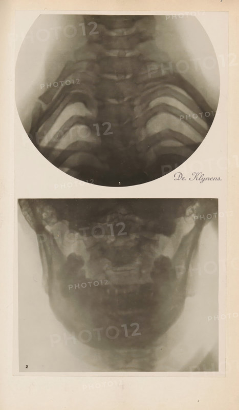 X-ray of an upper and lower jaw, photograph, page, name: 'Dr. Klynens.', c. 1904 - in or before 1909, photographer, paper, gelatin silver print, developing gelatin silver print, height 89 mm x width 103 mm, Photo in section at the back of the book., X-ray examination, jaw (human), A vertical sheet showing two grayscale circular and rectangular radiographic images of a head and upper chest area mounted on a light background, the top image is a round radiograph showing a frontal view of the upper spine and rib outlines with soft gradients of gray and dark curved bone structures, and the lower rectangular radiograph shows a frontal view of the lower skull and jaw with blurred bone contours and symmetric darker areas at the sides, both images bordered by a pale mat and surrounded by an off-white page.