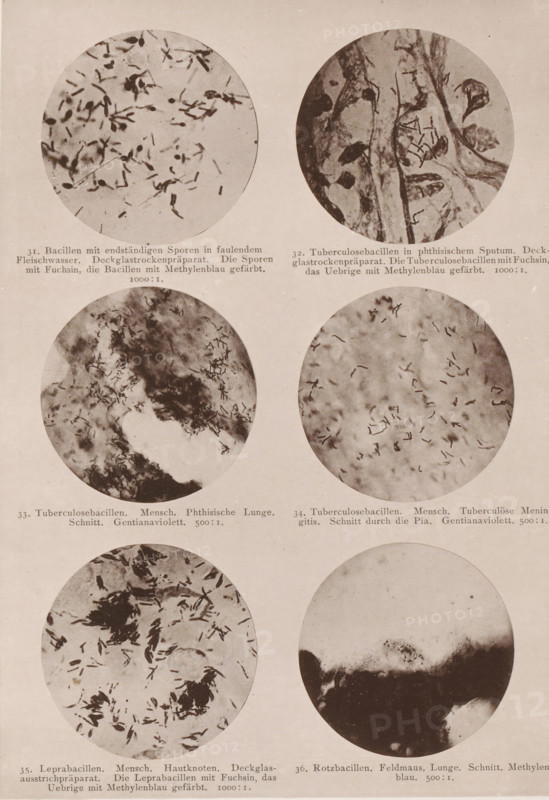 Six microscope images of bacteria, including tuberculosis and leprosy bacilli, page, photomechanical print, number: 'Tafel VI.', inscription: '31. bacteria with end-to-end spores in faulendem Fleischwasser. Deckglassrockenpräparat. Those Spores with Fuchsin, those Bacilli with Methylenblau produced. 1000:1. 32. Tuberculosis Bacilli in Phthisis Sputum. Deckglassrockenpräparat. The Tuberculosis Bacilli with Fuchsin are produced with Methylenblau. 1000:1. 33. Tuberculosis bacilli. Mensch. Phthisian Lunge. Schnitt. Gentianaviolett. 500:1. 34. Tuberculosis bacilli. human Tuberculosis Meningitis. Schnitt durch die Pia. Gentianaviolett. 500:1. 35. Leprosy bacilli. Mensch. Hautknoten. Deck glass sauce stick preparation. The Leprosy Bacilli with Fuchsin are produced with Methylenblau. 1000:1. 36. Rotz bacilli. Feldmaus, Lunge. Schnitt. Methylenblau. 500:1.', photographer: Carl Günther, Berlin, maker: Friedrich Julius Klinkhardt, Leipzig, c. 1880 - in or before 1890, Saxony, paper, collotype, ph...
