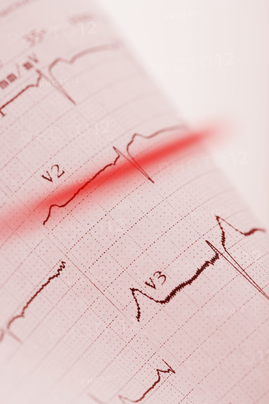 Closeup of heart monitor printout.