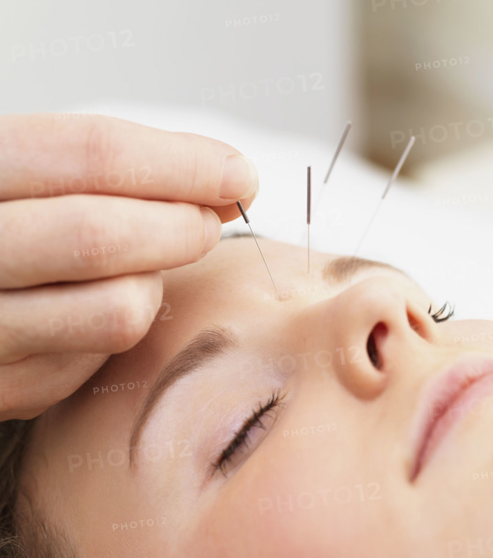 Woman receiving acupuncture. Date : 2008