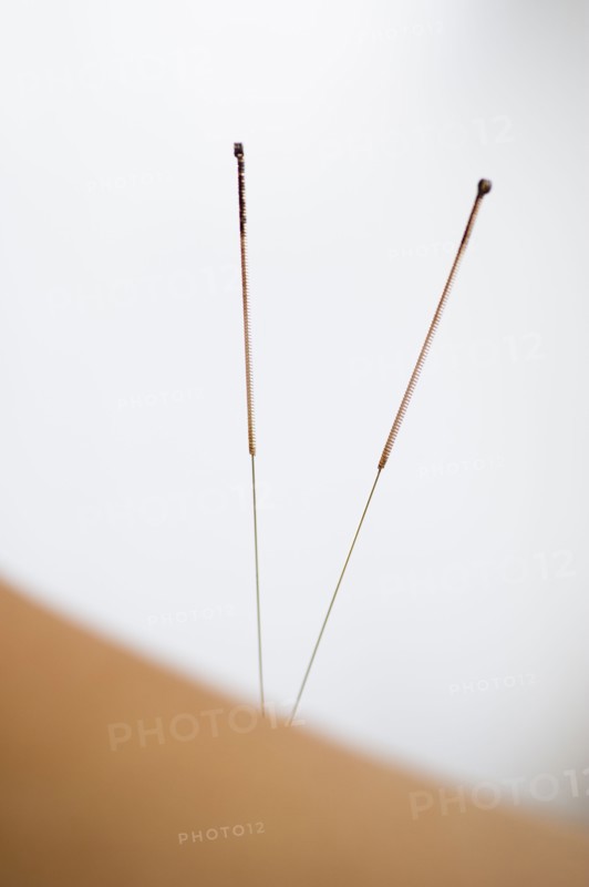 Acupuncture needles.