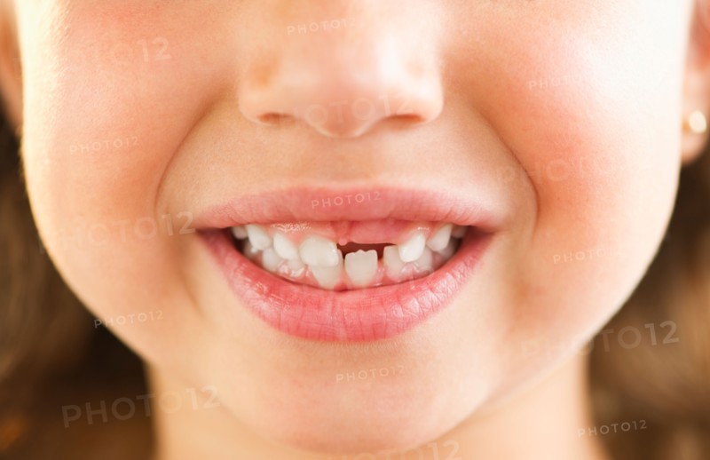Close-up of girl's (2-3) mouth with some teeth missing. Photo : Daniel Grill