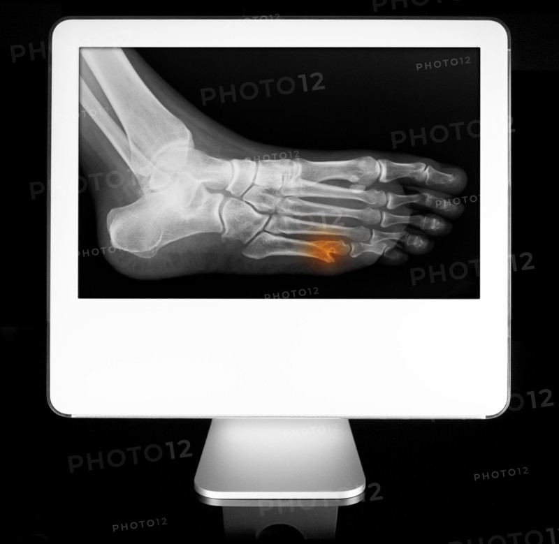 Broken toe appearing on diagnostic monitor. 
Photo: Calysta Images
