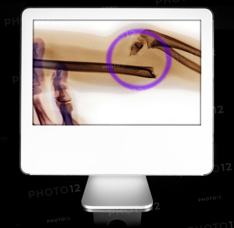 Bone fracture appearing on diagnostic monitor. 
Photo: Calysta Images