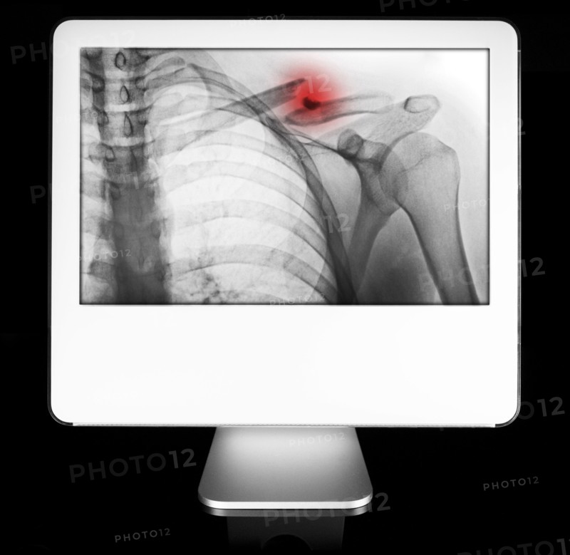 Arm fracture appearing on diagnostic monitor. 
Photo : Calysta Images