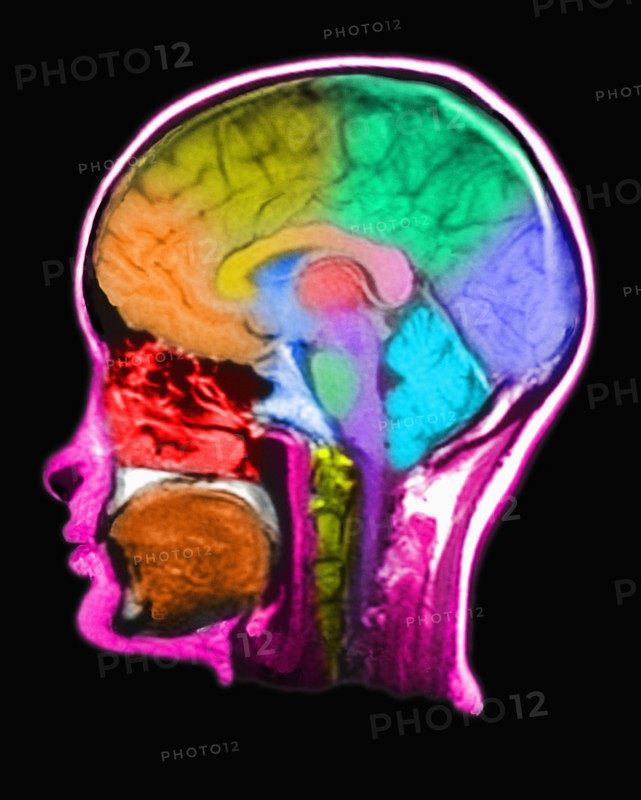 MRI Scan of human head. 
Photo: Calysta Images