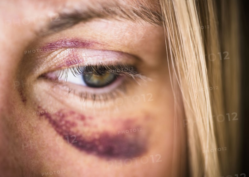 Portrait of woman with black eye. Photo: Jamie Grill