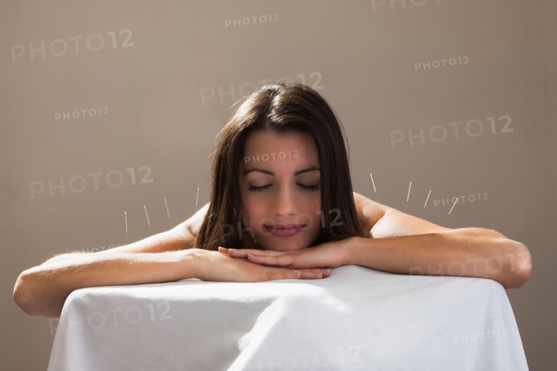 Woman laying on stomach with acupuncture needles in her shoulders. Photo : Mike Kemp