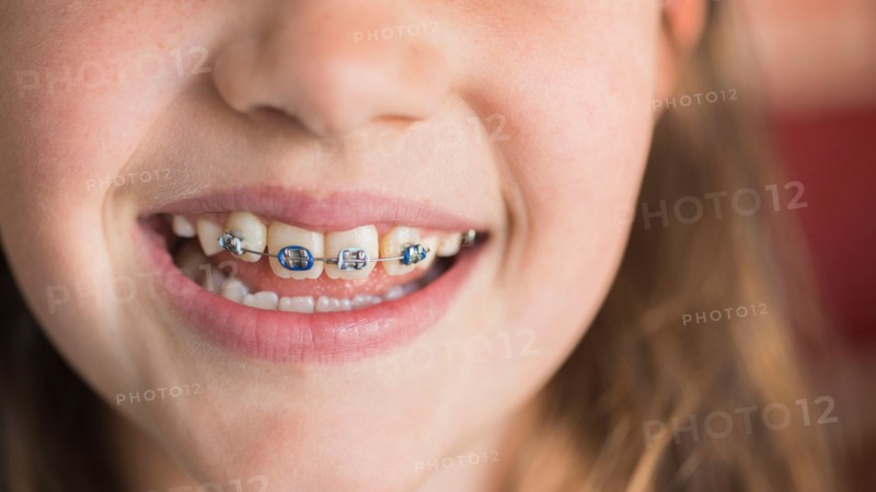 Close up of girl's (8-9) mouth with braces.