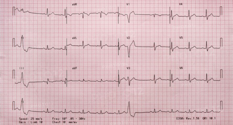 Electrocardiogram on red graph paper