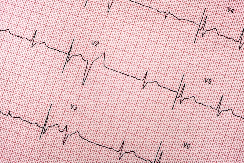 Electrocardiogram on red graph paper