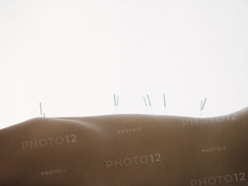 Close up of woman with acupuncture needles in back