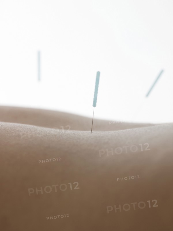 Close up of acupuncture needles in back of woman