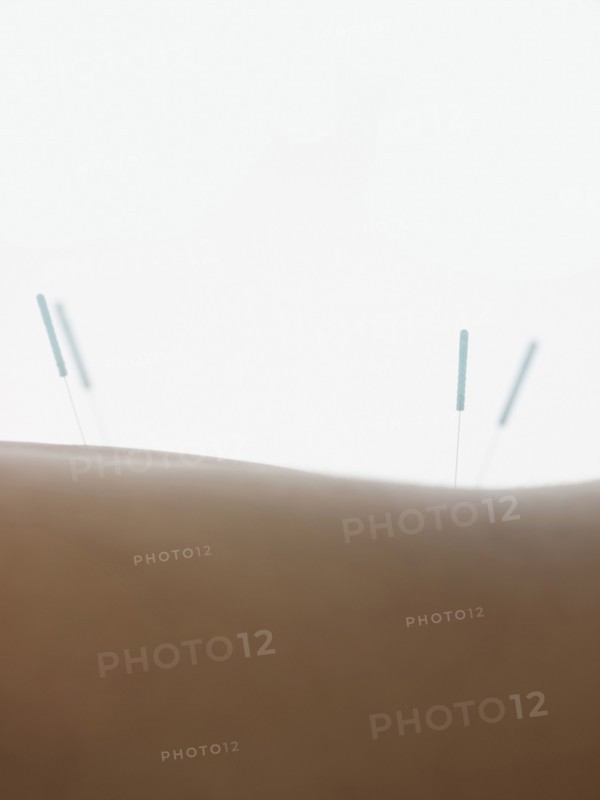 Close up of acupuncture needles in back of woman
