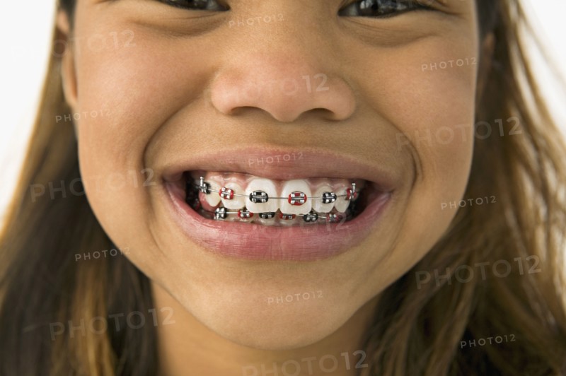 Asian girl smiling with braces