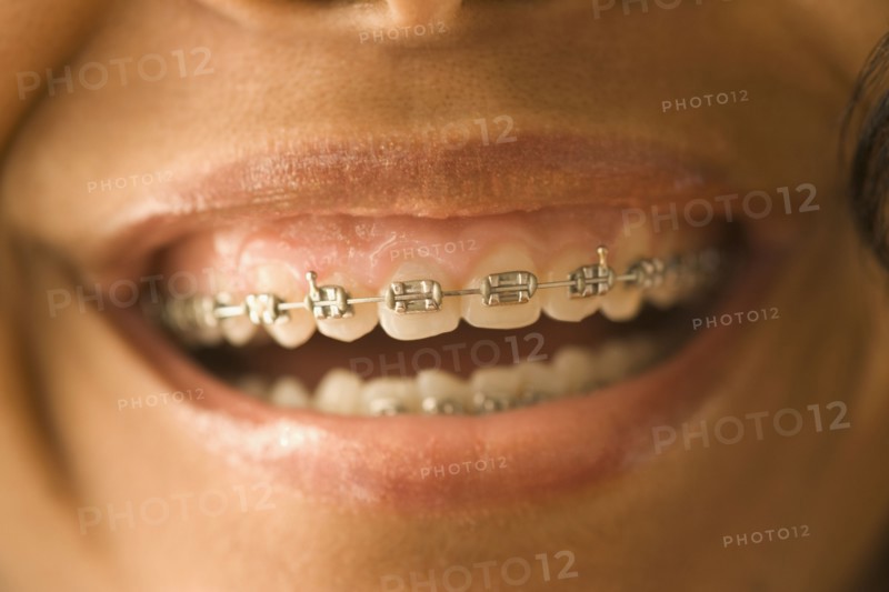 Close up of African woman with orthodontic braces